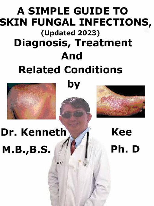 Upplýsingar um A Simple Guide to Skin Fungal Infections, (Updated 2023) Diagnosis, Treatment and Related Conditions eftir Kenneth Kee - Biðlisti